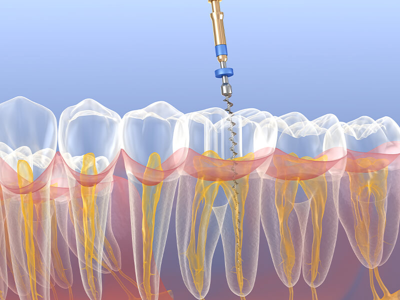 tdm workshop fundamentals in endodontics